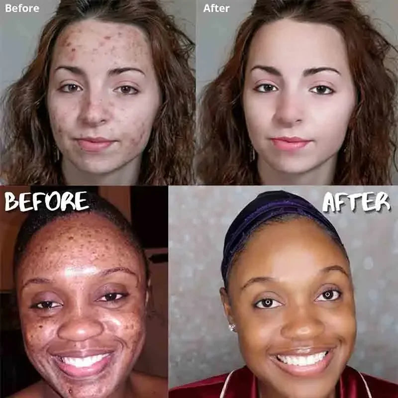 a woman's face before and after acne treatment