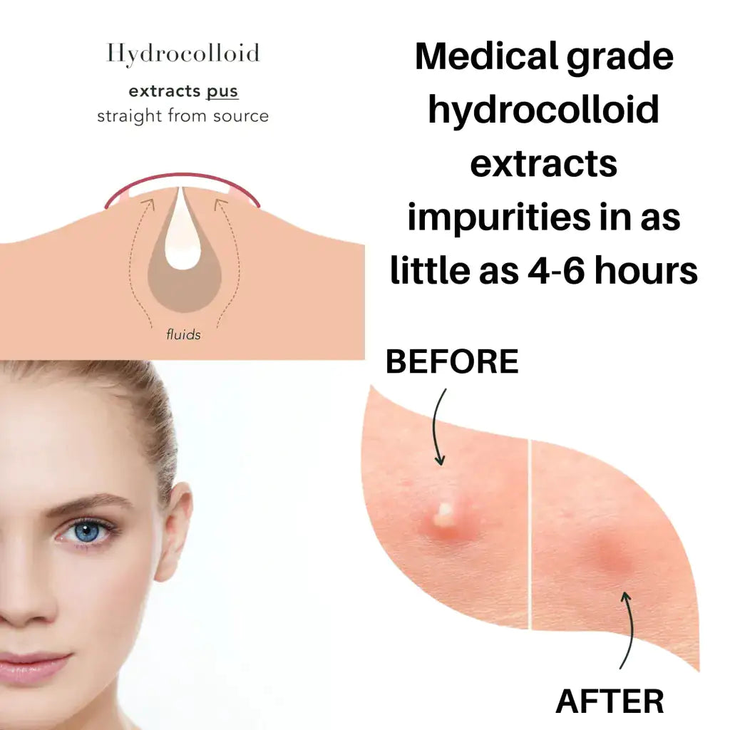 An informative illustration showcasing the effectiveness of Blooming Violets' Glow In The Dark Hydrocolloid Acne Pimple Patches, highlighting how they extract impurities from the skin. Perfect for those fighting acne, these glow in the dark pimple patches are an essential addition to any skincare routine. Remember to take advantage of free shipping on these skincare essentials.